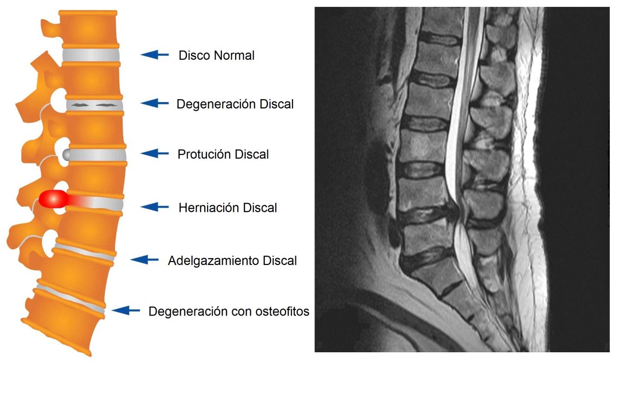  Tratamiento Hernia Discal Tratamiento medico no quirúrgico de la